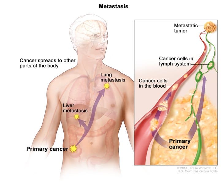 Lymph Nodes metastatic cancer