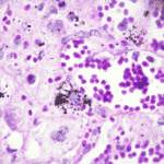pathology report cells